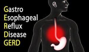 gerd_2